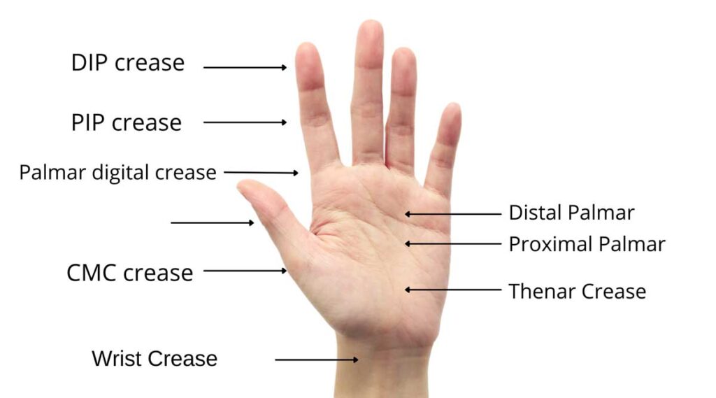 5 hand creases every hand therapist should know
